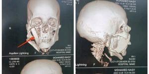 جامعة أسيوط تنجح في إجراء عملية إزالة قطعة حجرية داخل وجه مريض 