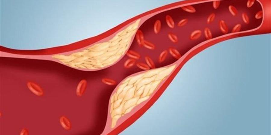 خلال شهر.. وجبة لذيذة يمكنها خفض الكوليسترول الضار