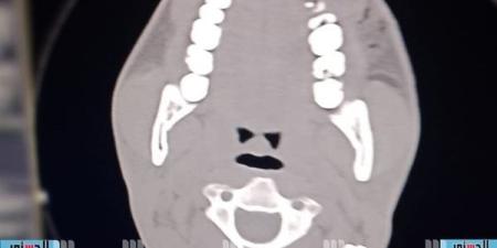 بدء تفعيل جراحات الوجه والفكين بمستشفى الضبعة المركزي في مطروح