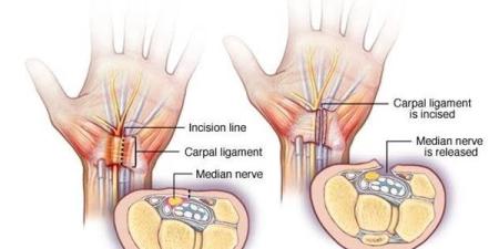 ما هي متلازمة النفق الرسغي وتأثيرها على الجسم؟