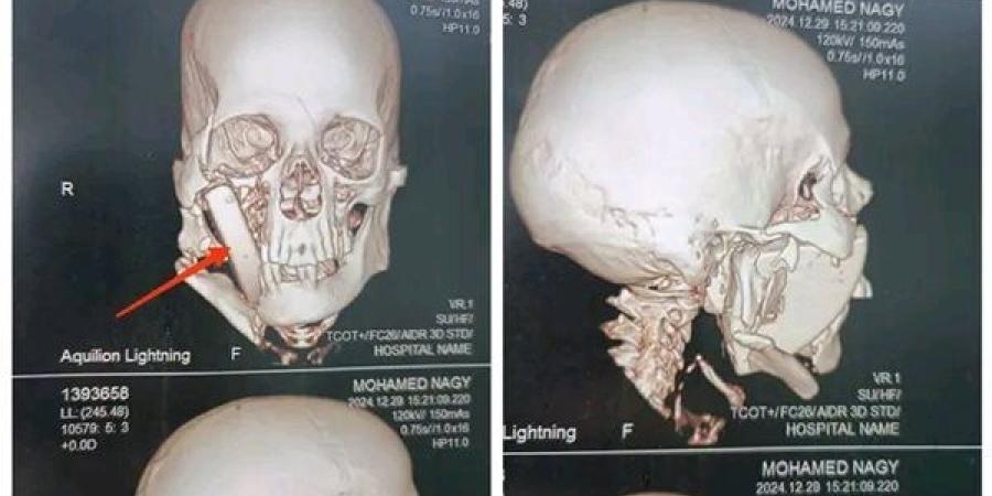 جامعة أسيوط تنجح في إجراء عملية إزالة قطعة حجرية داخل وجه مريض 