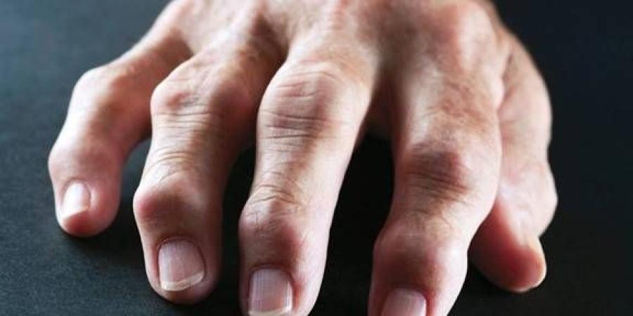 التهاب المفاصل الروماتويدي مرض مناعي مزمن يصيب المفاصل